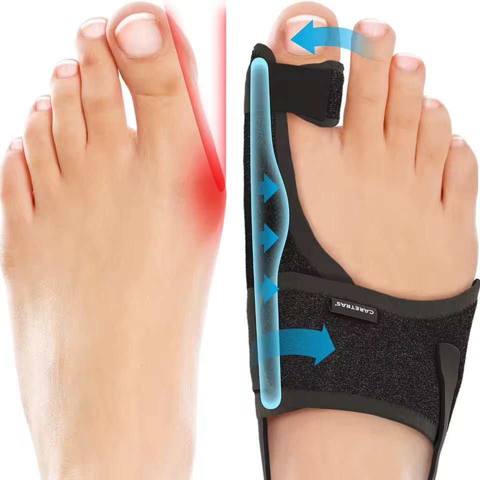 Nachtspalk Voor Scheefstand Van De Grote Teen Met Ergonomische Correctiesteun