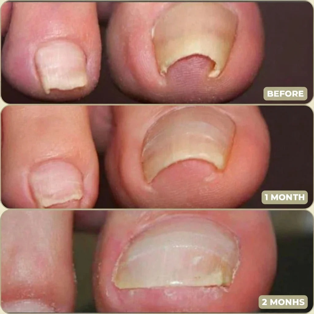 Toenail Correction Patches