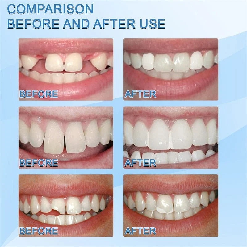 Moldable Tooth Gap Cover